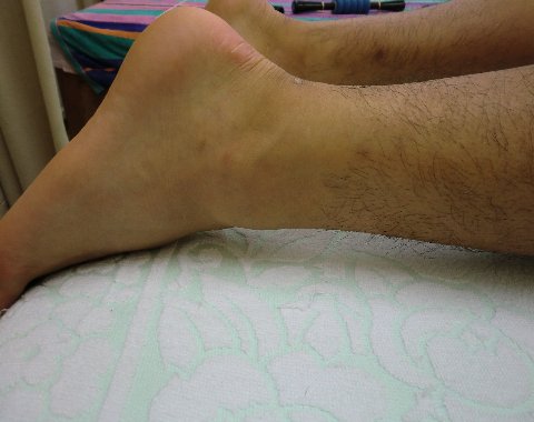 治療後の足首