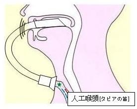 喉頭 電気 式 人工